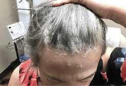 Before Image: Scalp Psoriasis - front