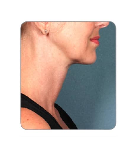 After Image: Case 1 - right-side