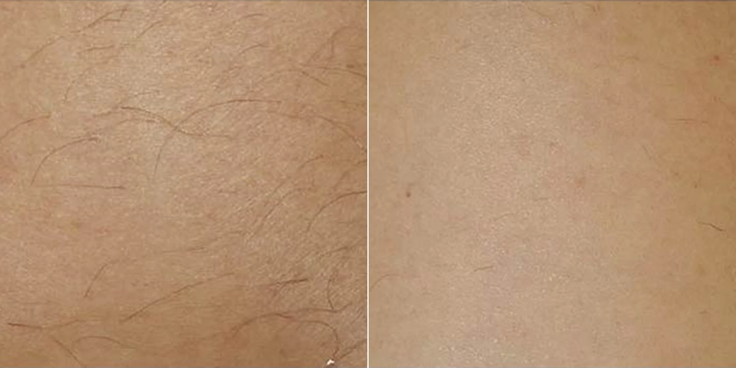Laser hair removal, leg, 3 treatments