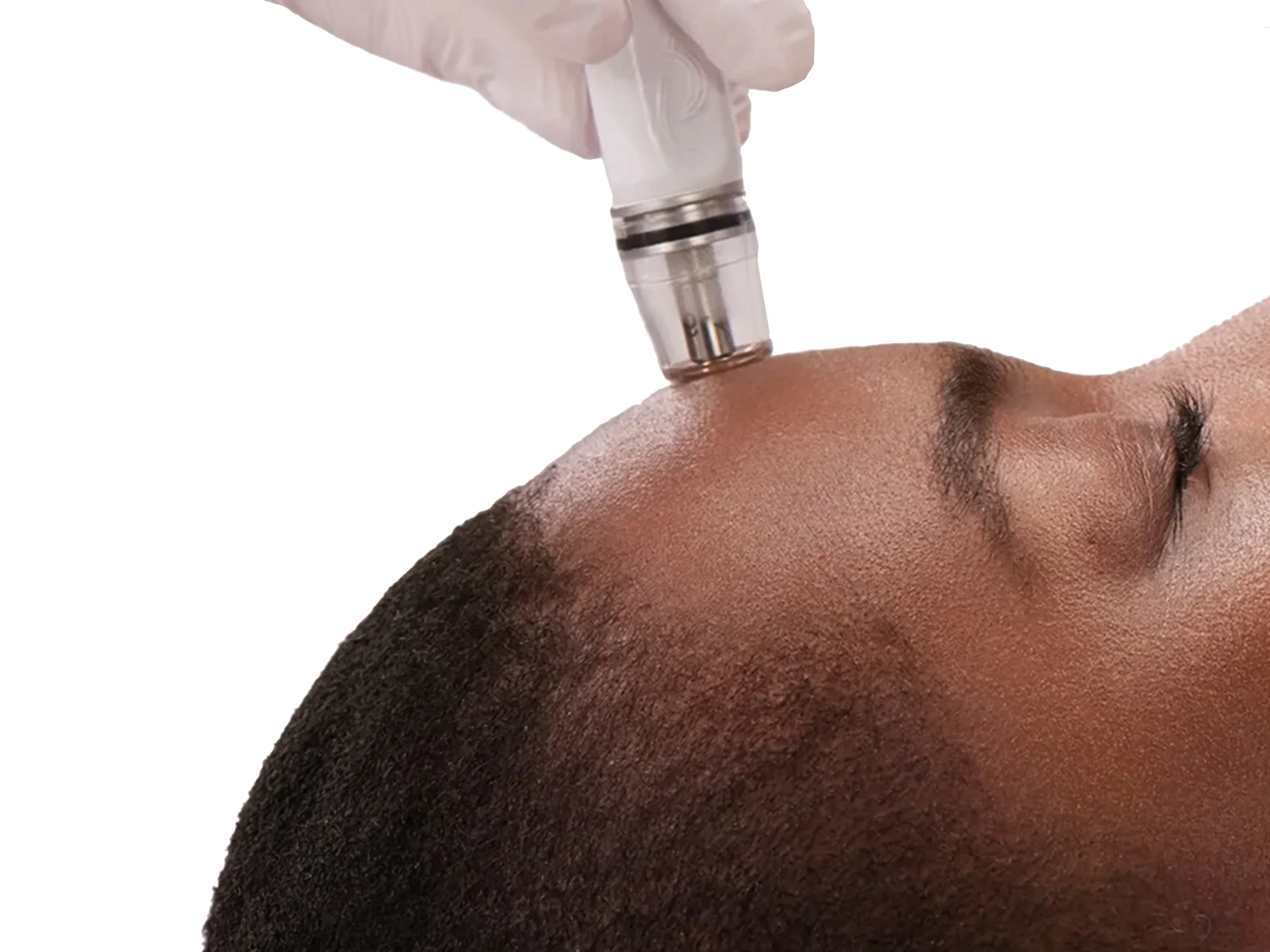 A DiamondGlow wand gently exfoliating a man's forehead
