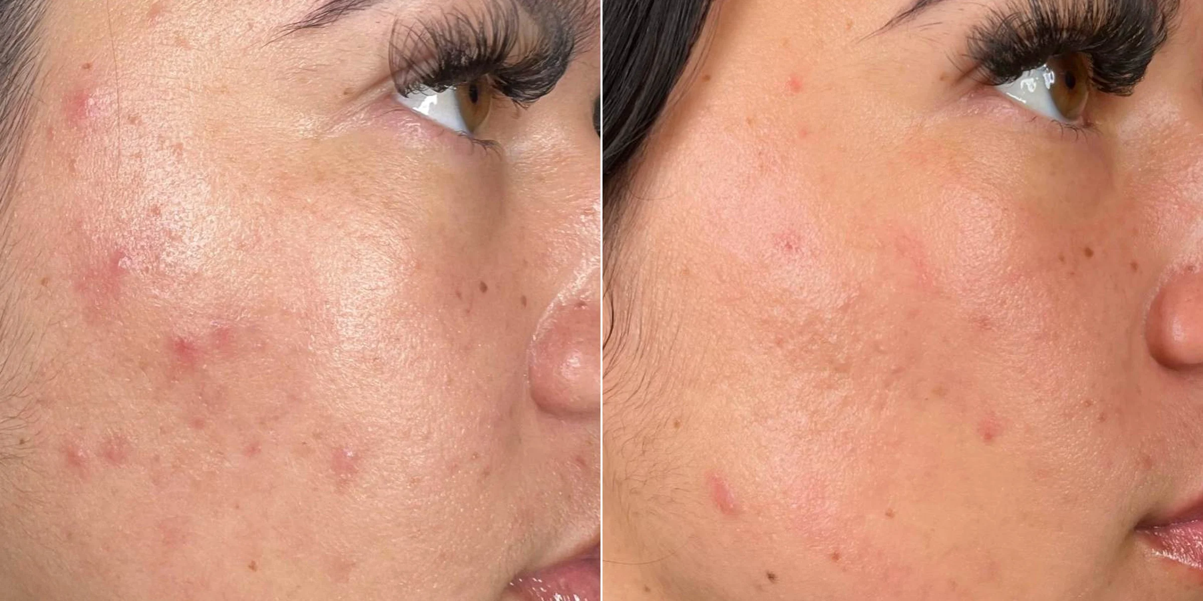 HydraFacial for acne-prone skin
