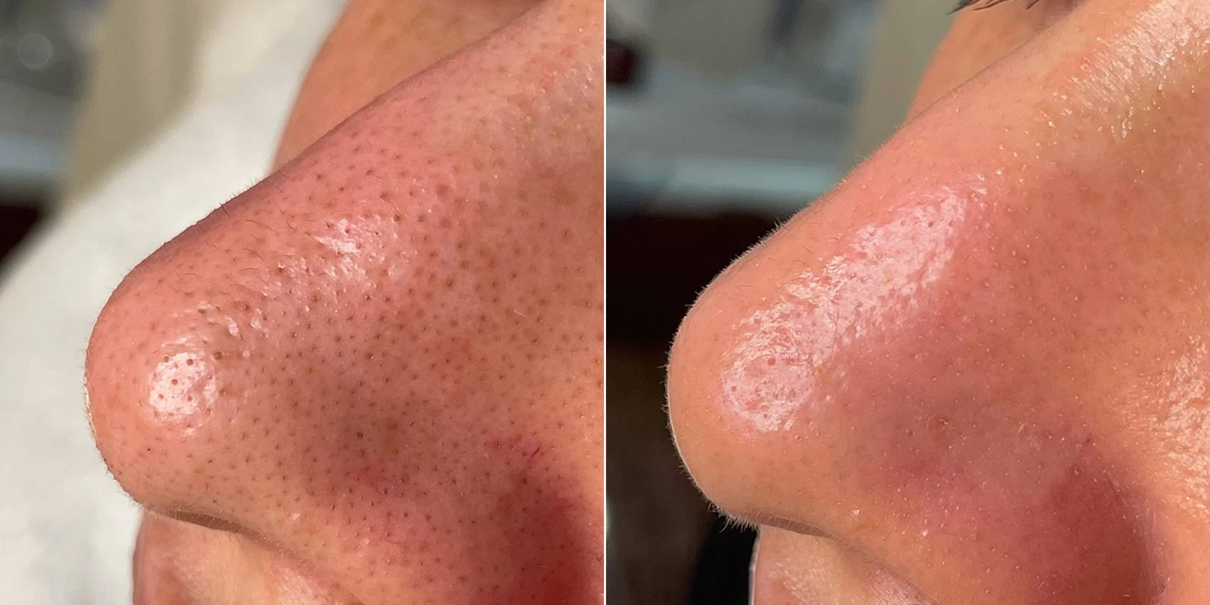 HydraFacial for clogged pores