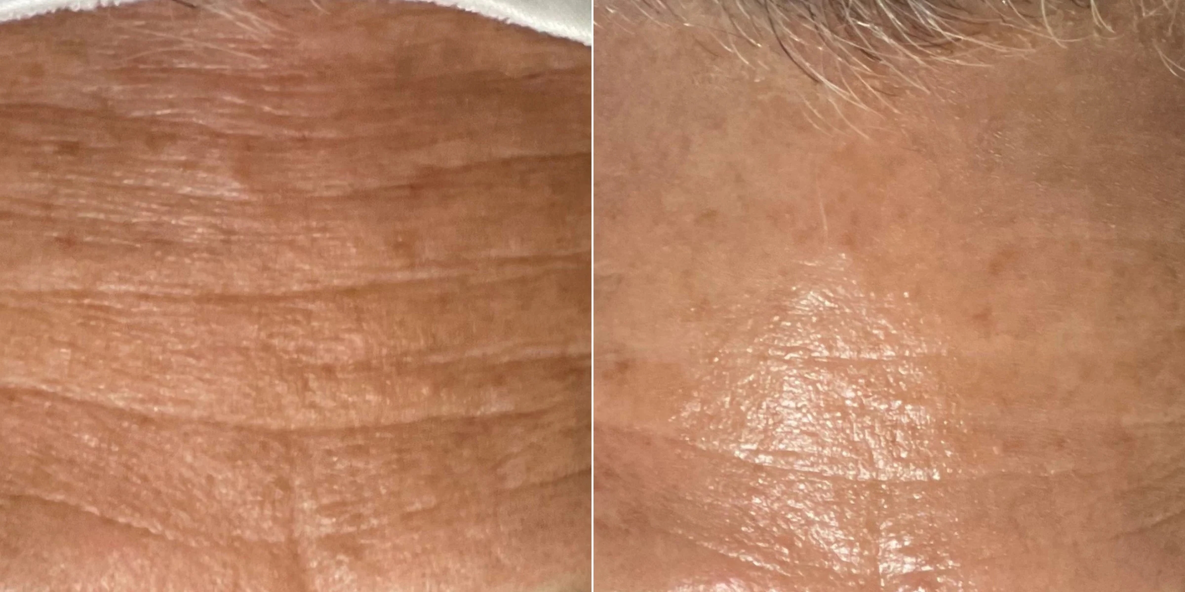 HydraFacial for fine lines