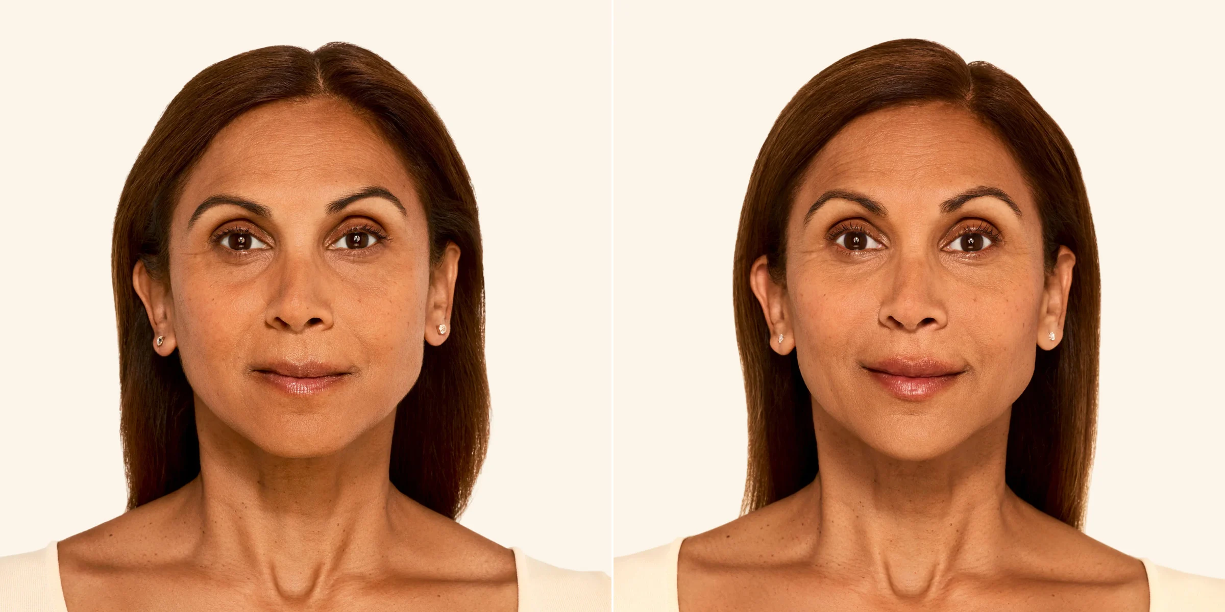 Juvéderm for cheeks, temples, smile lines and jawline
