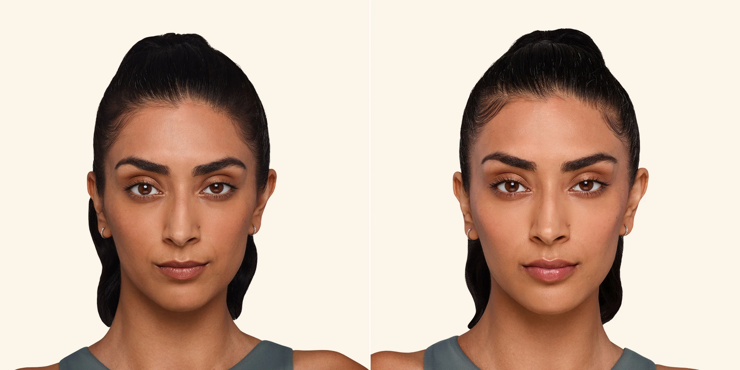Juvéderm for cheeks, chin, under-eyes, smile lines and lips