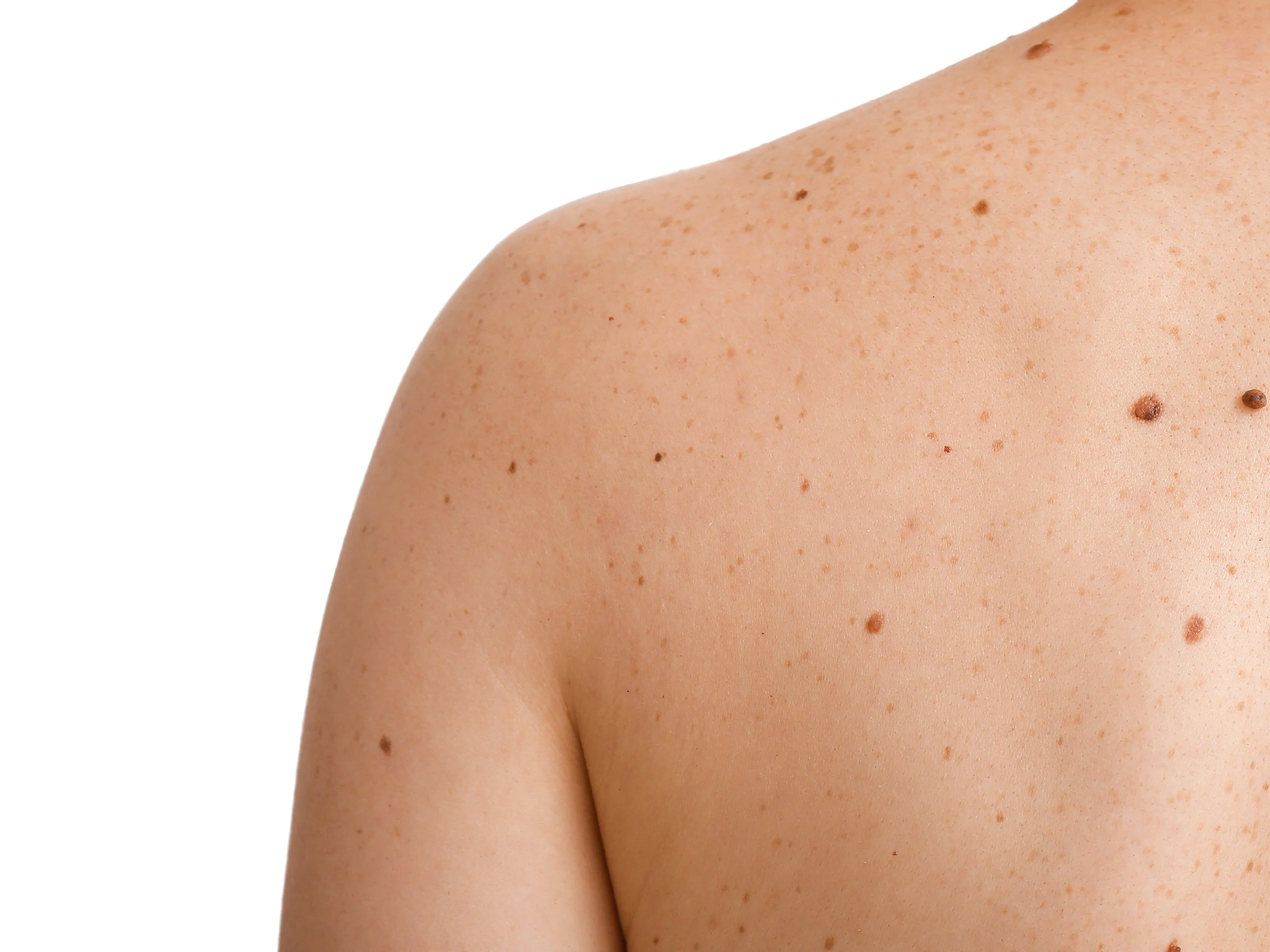 A shoulder and upper back with many moles and freckles