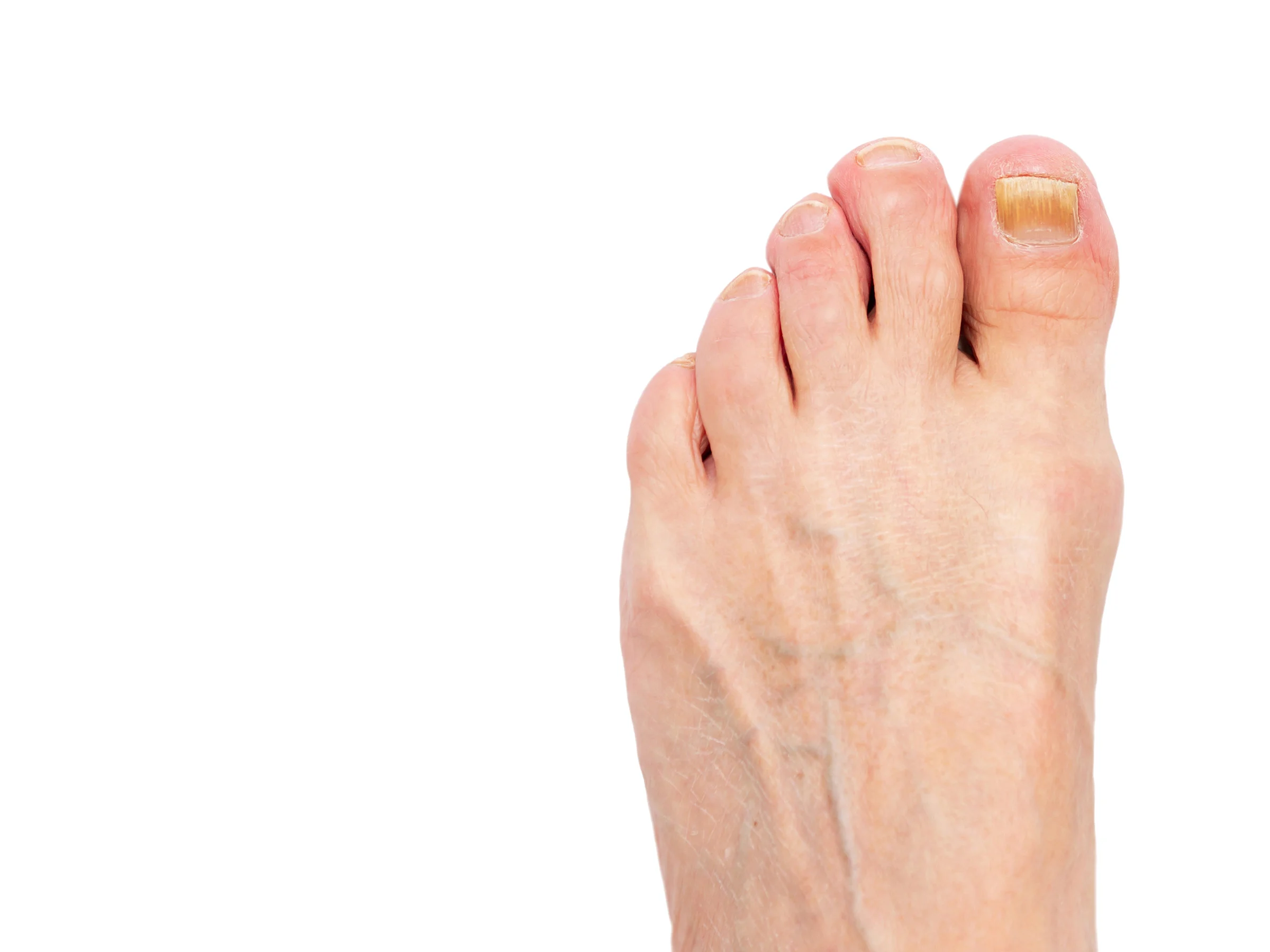 A foot with a thickened, yellow big toenail