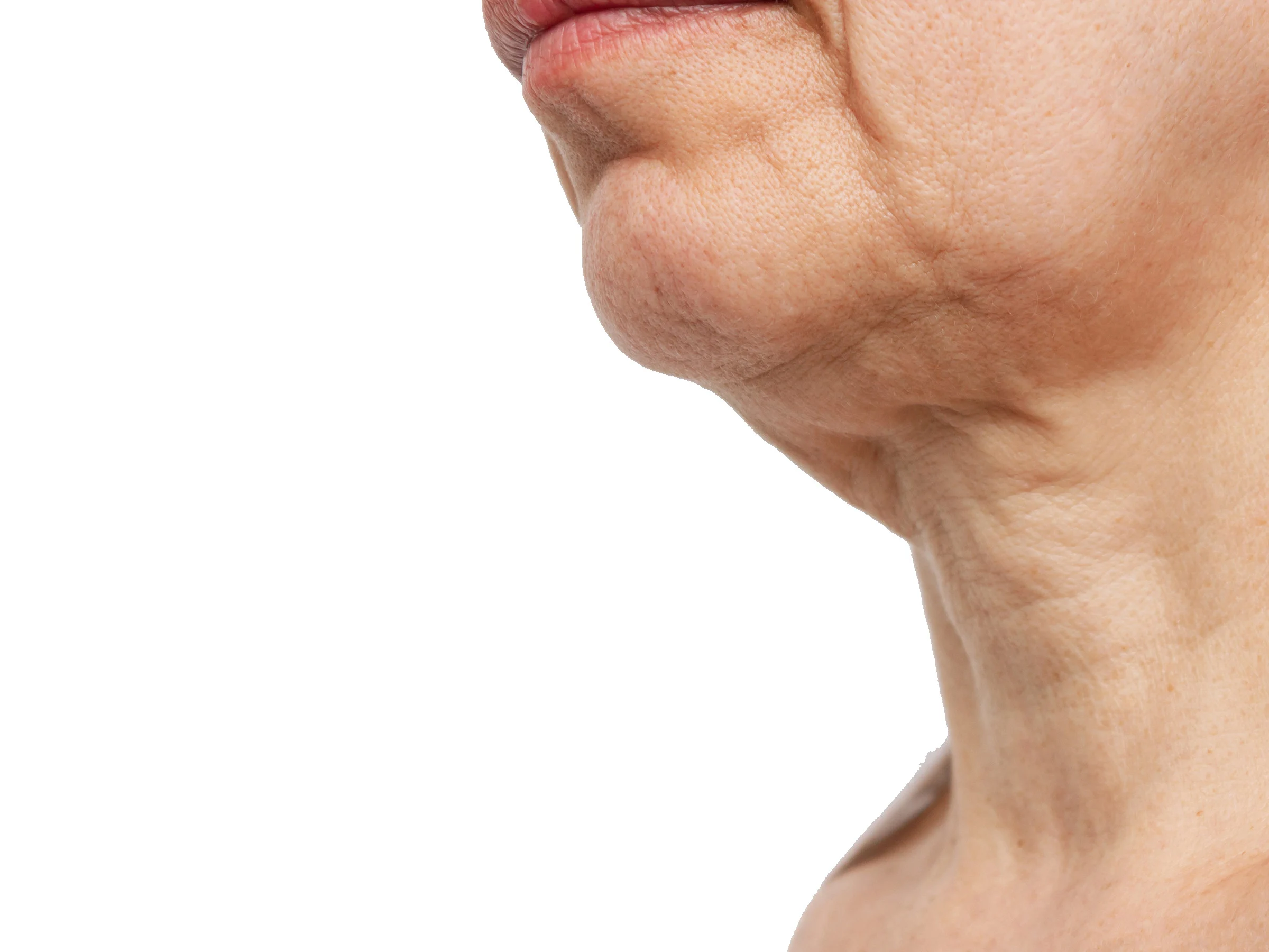 Side profile of a lower face and neck with loose, crepey neck skin