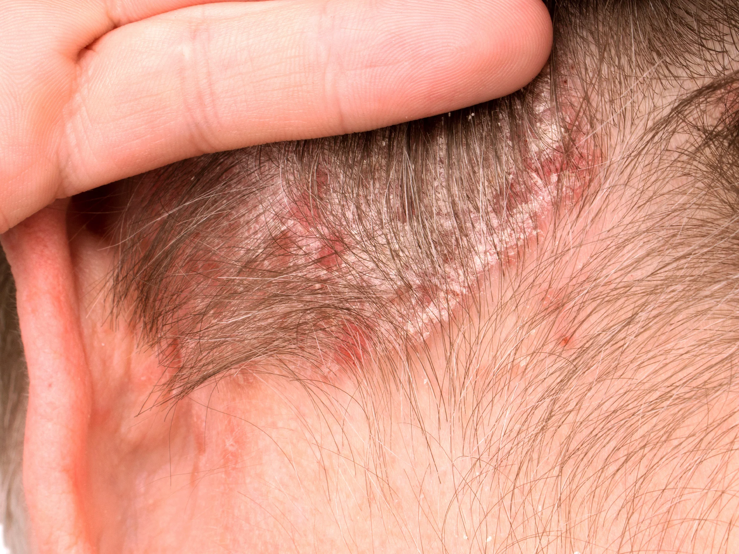 Close-up of scalp psoriasis: red patches with silvery scale along the hairline behind the ear