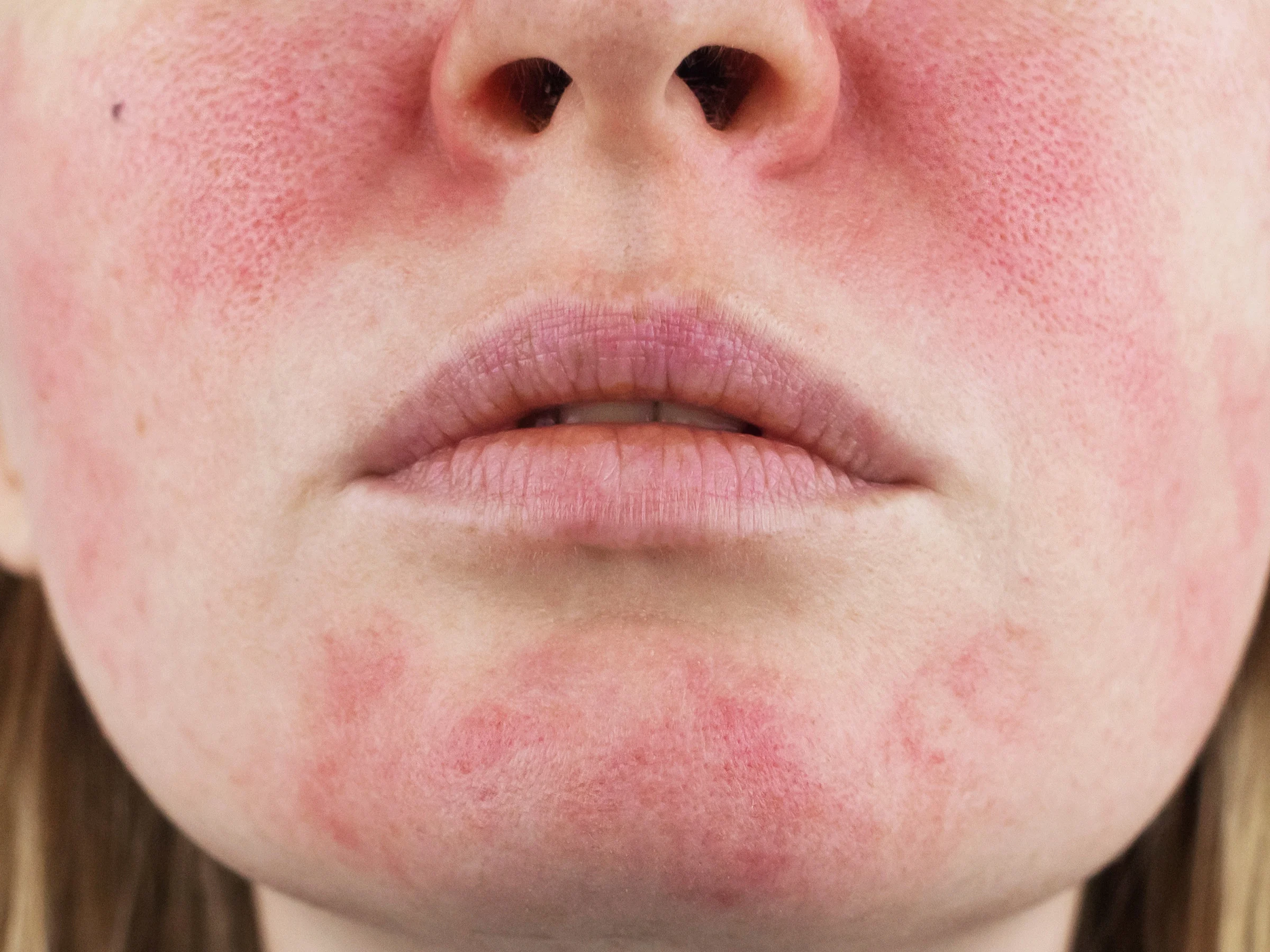 Close-up of rosacea: redness across the cheeks, around the nose and on the chin