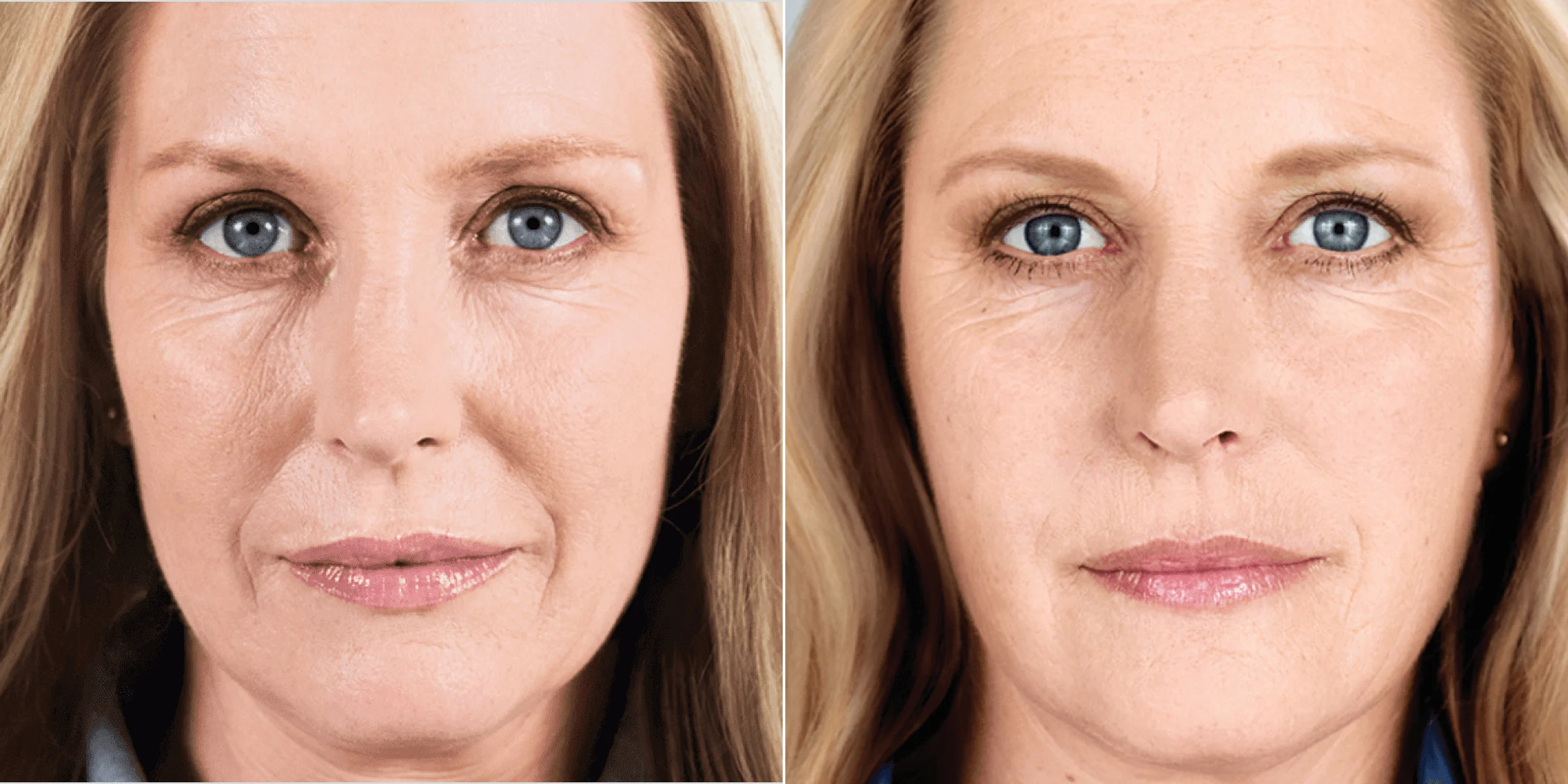 Sculptra for smile lines and facial wrinkles, 25 months