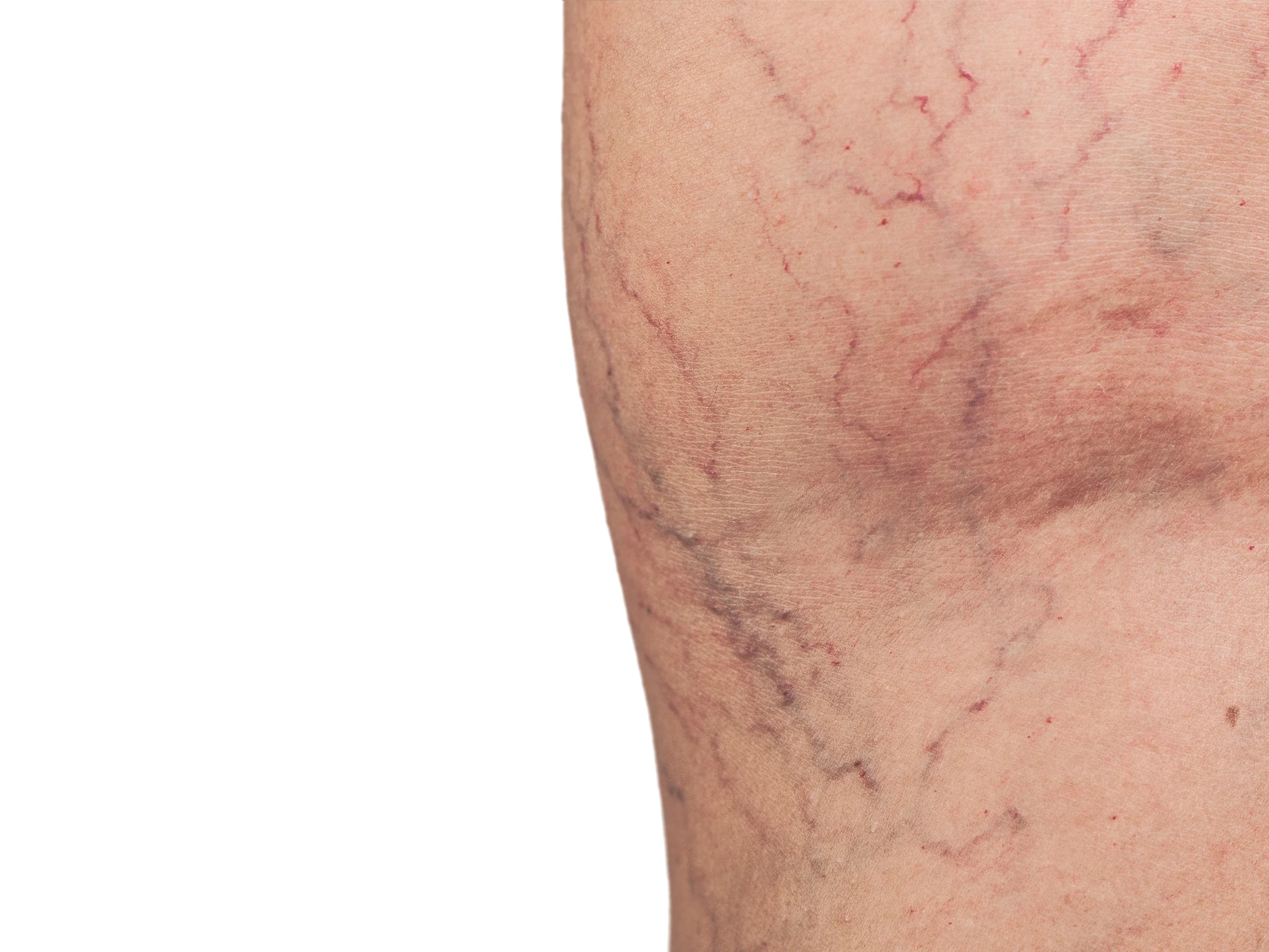 Close-up of red and purple spider veins on the skin of a leg