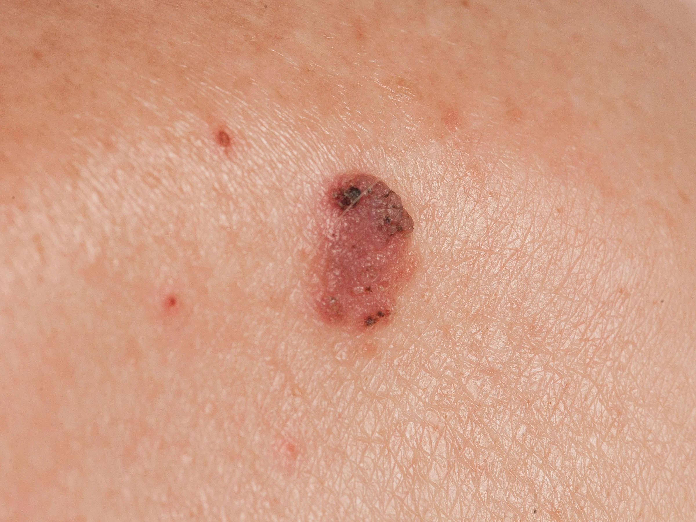 Close-up of a squamous cell carcinoma: a raised, crusted, red-purple patch on sun-exposed skin