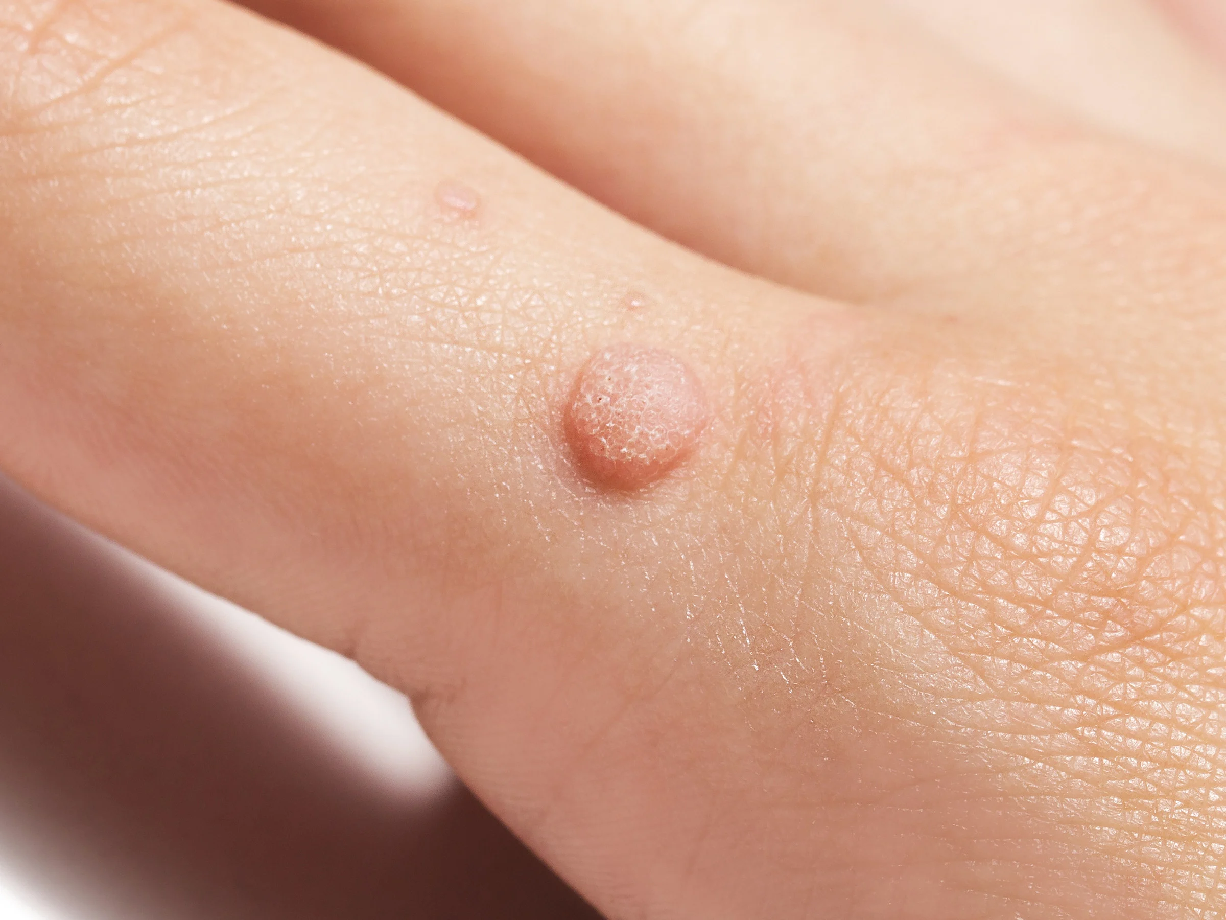 Close-up of a common wart: a rough, raised bump on a finger